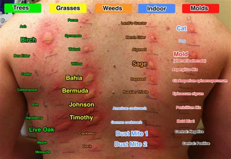 allergy skin testing chart